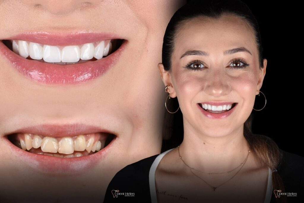 Faceta de Resina ou Porcelana