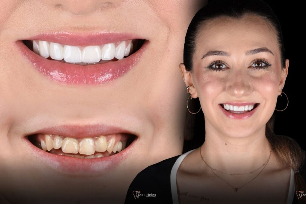 Front Teeth Crowns in Antalya