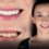 Front Teeth Crowns in Antalya