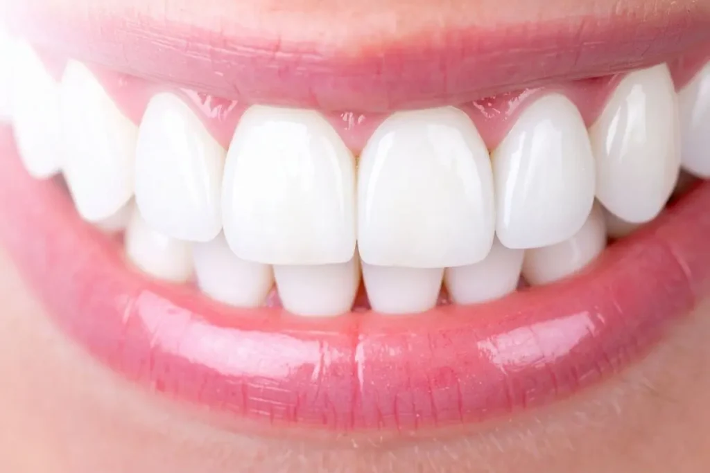 Quanto tempo duram os resultados do branqueamento dentário