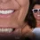 Zirconium Crowns Cost in Antalya