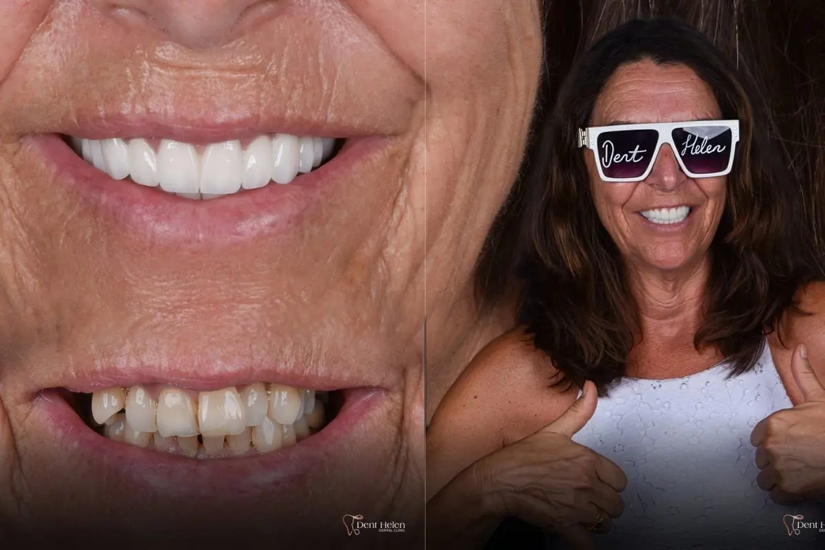 Zirconium Crowns Cost in Antalya