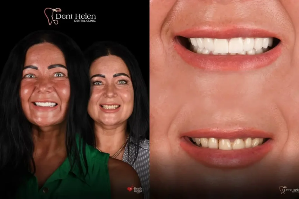 Zirconium Crowns Cost in Turkey