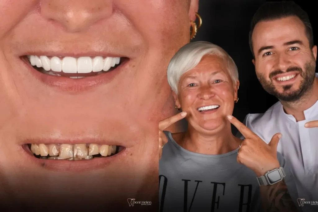 Smile Makeover Cost in Antalya