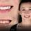 Smile Makeover in Antalya