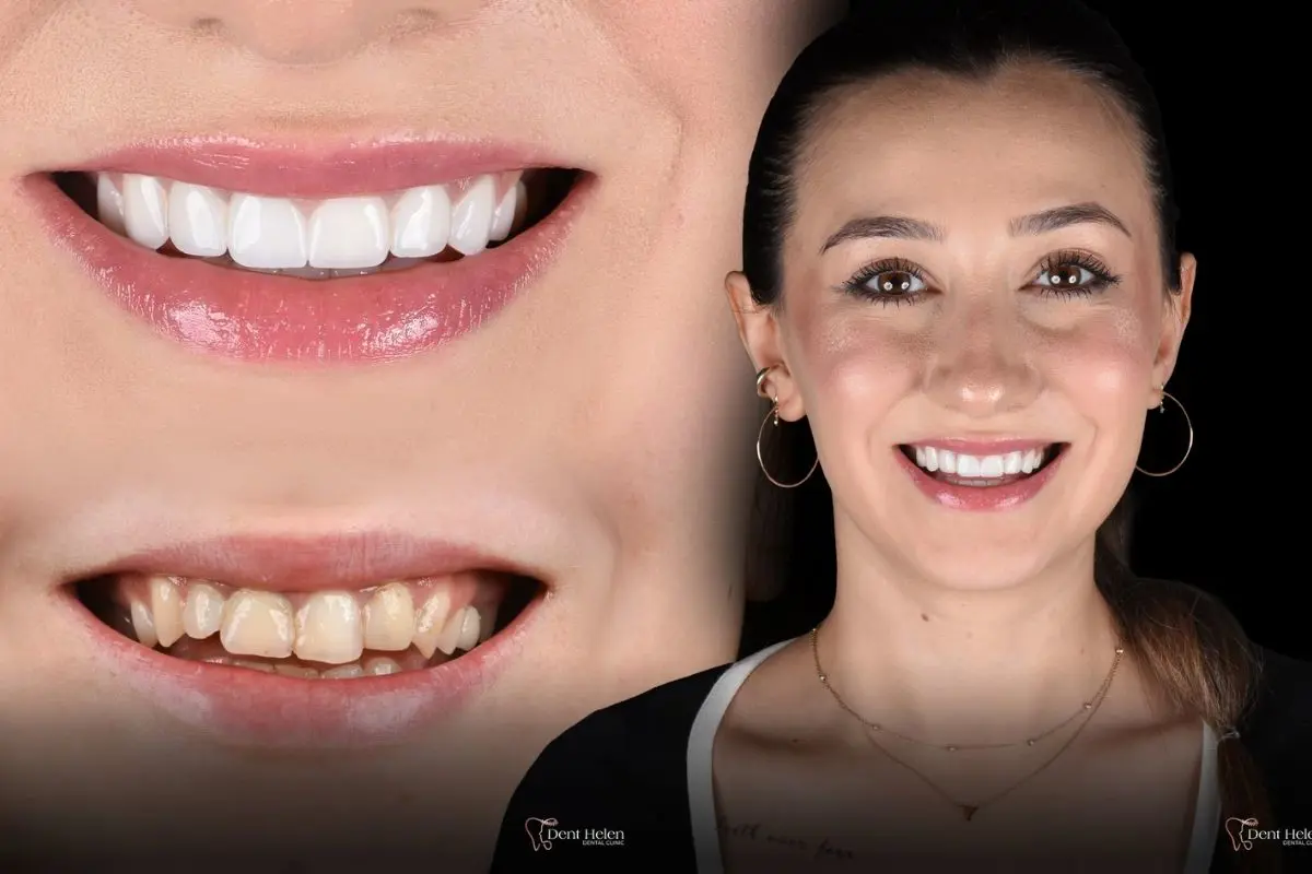 Smile Makeover in Antalya