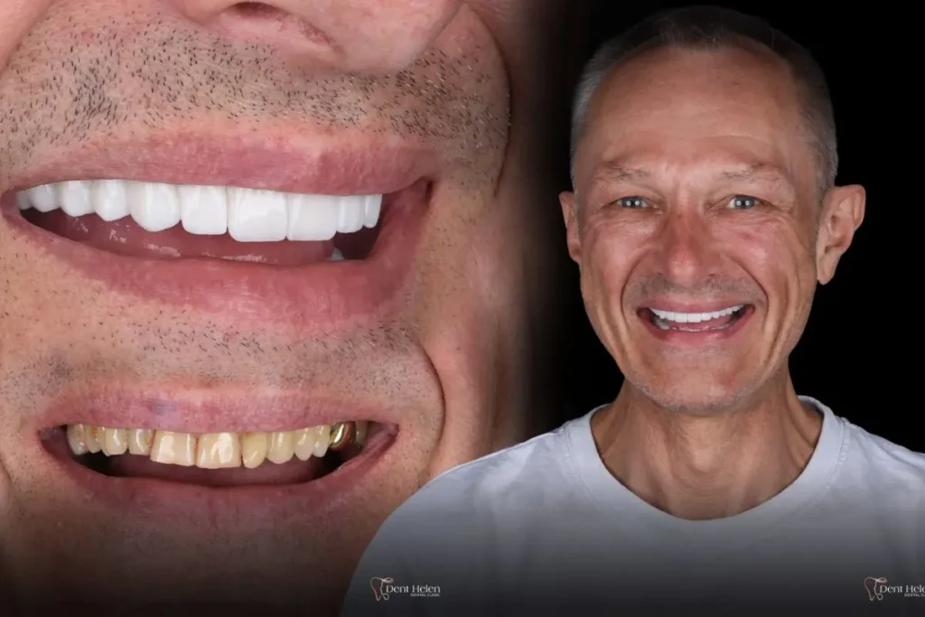 Veneers, Crowns